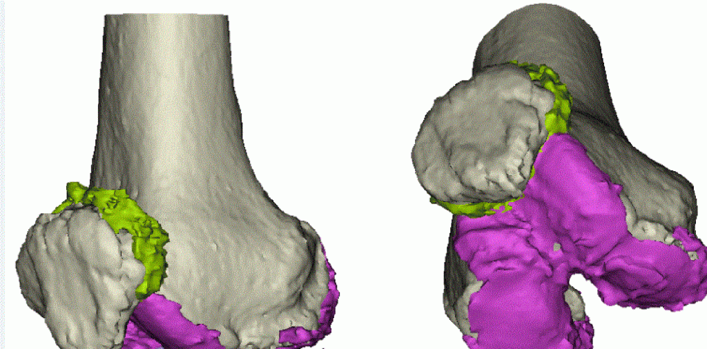 New database of patient anatomical models from different chondral lesions under construction