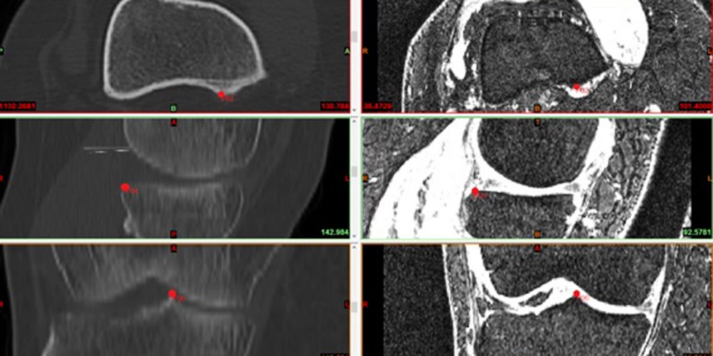 Development the first patient specific open access web database of damaged chondral cartilage