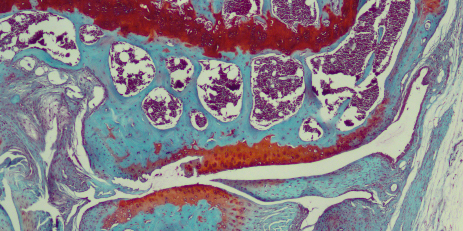 Osteoarthritis with cartilage degeneration