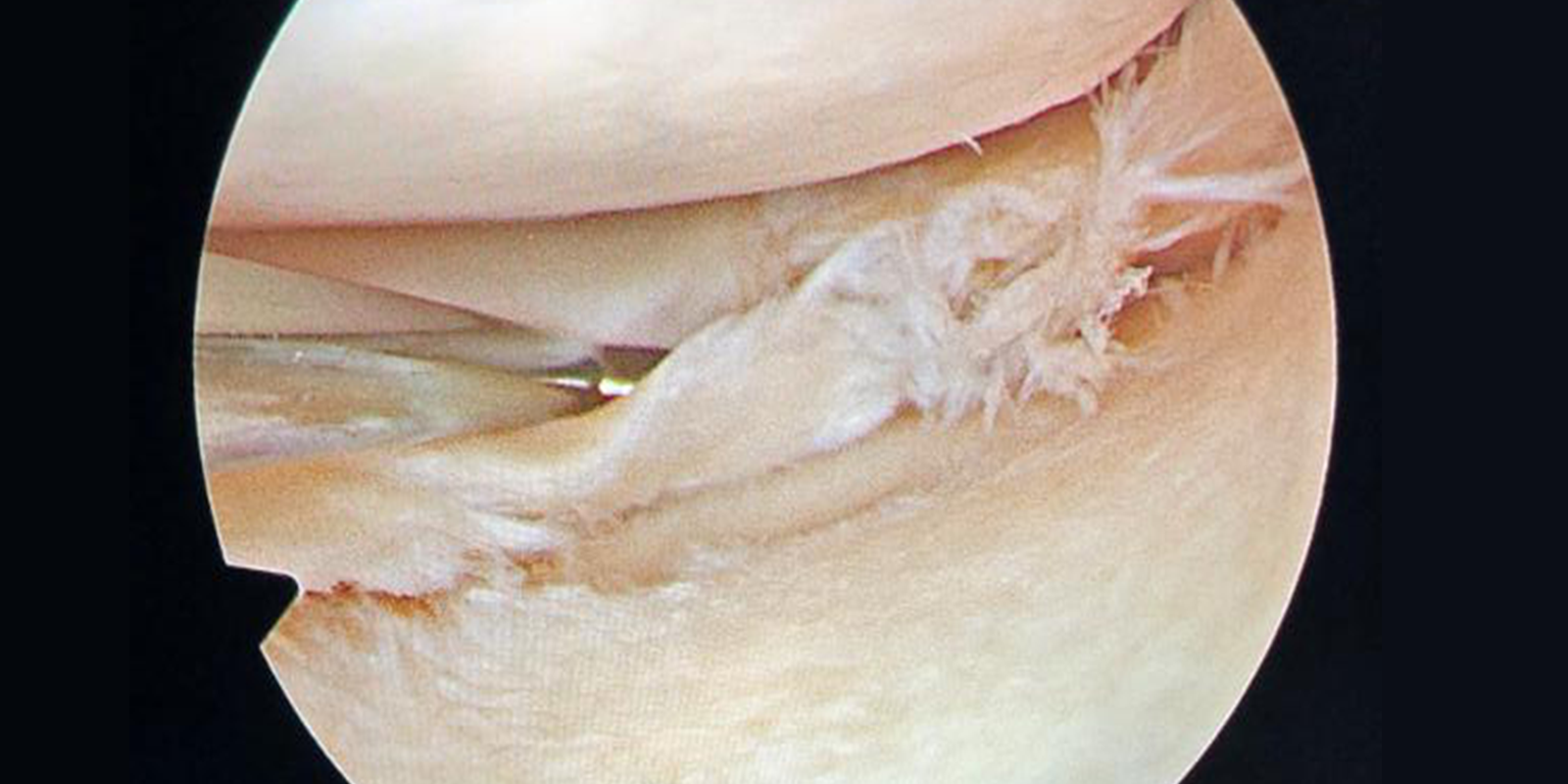 severe_lesions_chondyle_lesion