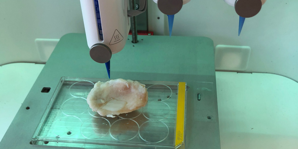 3D bioprinting in situ into an Osteoarthritic cartilage lesion