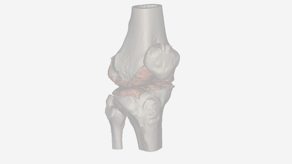 Beta Version chondral lesion database (clDB) online (https://restore-project.ru.is/database)